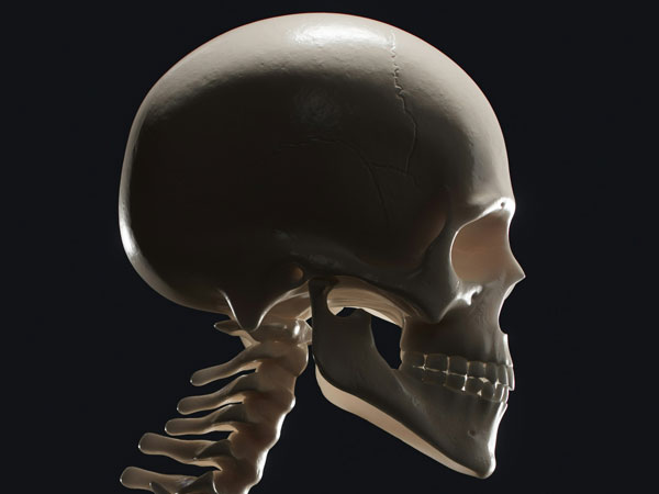 LCU - Lambdoid Craniosynostosis