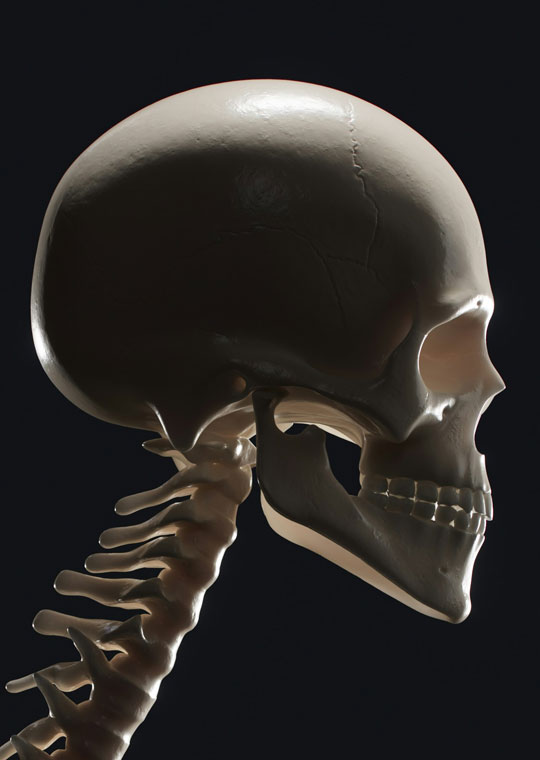 LCU - Lambdoid Craniosynostosis
