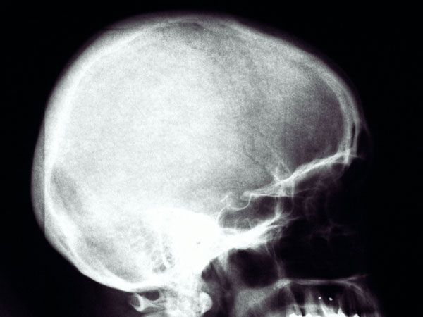 LCU - Sagittal Craniosynostosis