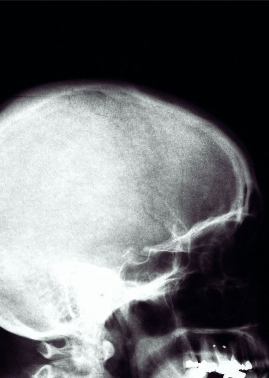 LCU - Sagittal Craniosynostosis
