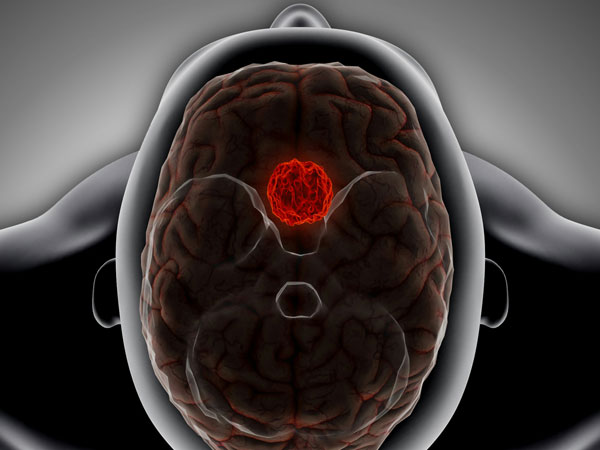 LCU - Tumours