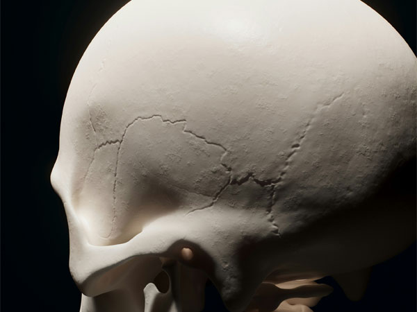 LCU - What is Craniosynostosis